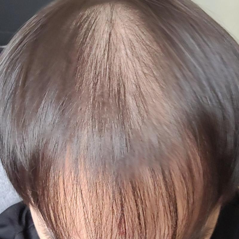 22살 후천적 탈모 가망있을까 형들,,