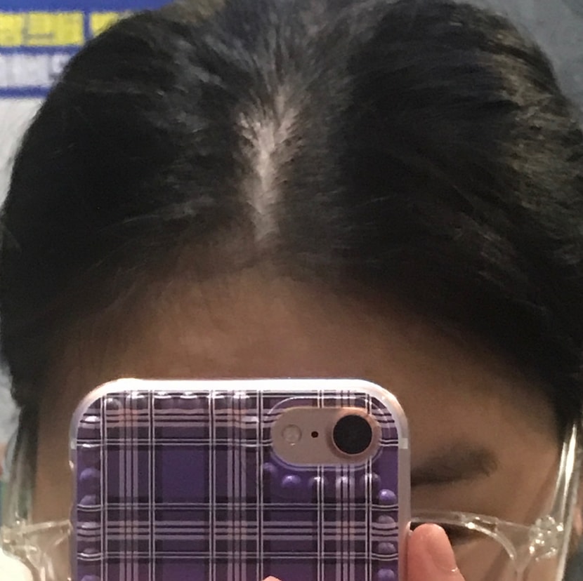 현재 가르마 정수리 상태2