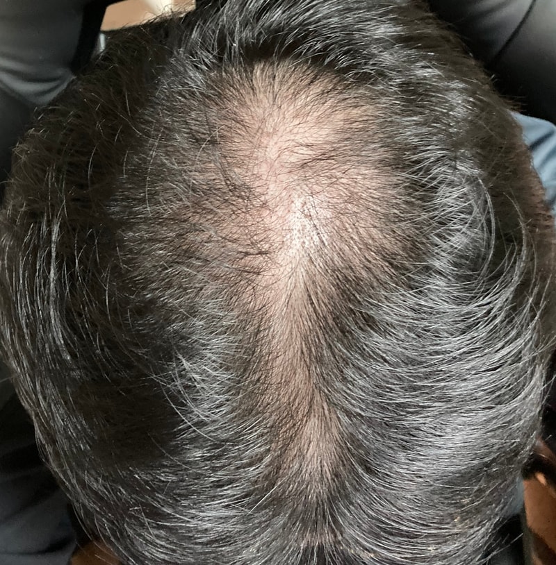 ハ...薄毛で悩んでる文.. 憎い 憎い..