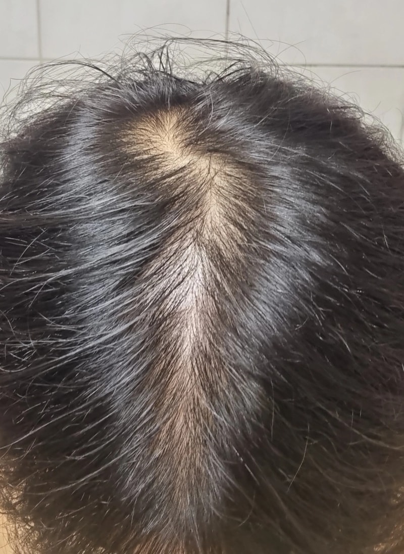 만 23세 남자 속알머리 탈모 고민입니다.