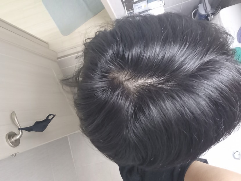 탈모치료전 