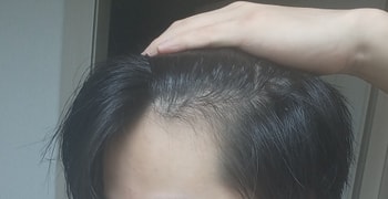 탈모치료후