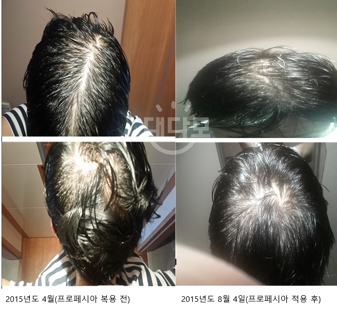 2015년 4월(약을 복용하기 전) 과 2015년 8월 4일(프로페시아4개월차의 변화) 입니다.