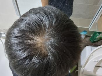현재(사실 더 진행된 것 같아 충격 받긴 했는데 미녹시딜의 쉐딩이라고 생각...)