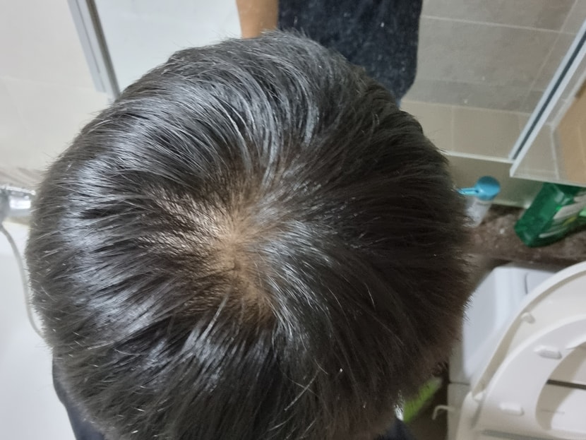 현재(사실 더 진행된 것 같아 충격 받긴 했는데 미녹시딜의 쉐딩이라고 생각...)