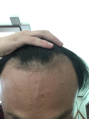 탈모 진행 하나도 안된 내 이마야..