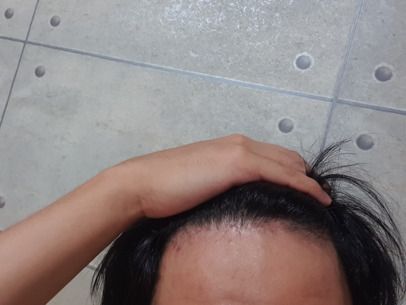 앞 헤어라인(뒤로 많이 밀려났네요ㅠㅠ)