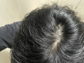 그저께 정수리 사진
