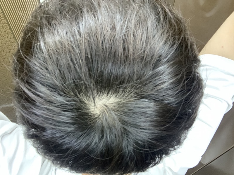 25세 탈모일까요