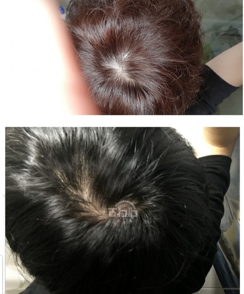 검정머리가 고 3초반 위에사진이 대학교1학년 초반(프페 복용한지 4개월정도+파마도 했음)