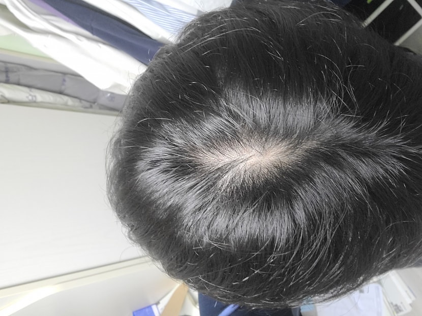 머리를 감을때 머리가 갑자기 많이 빠져서 걱정되어서 올립니다. 이 사이트가 처음이라 여기 게시판이 아니라면 알려주시길 부탁드려요.