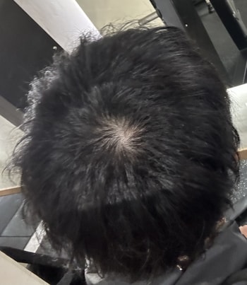 탈모인가? 태어났을때부터 이랬어 중학생 초등학생때도