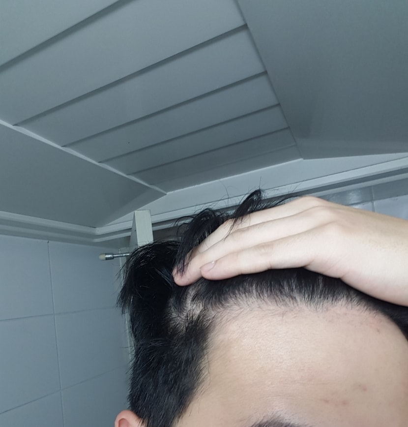 이마라인오른쪽