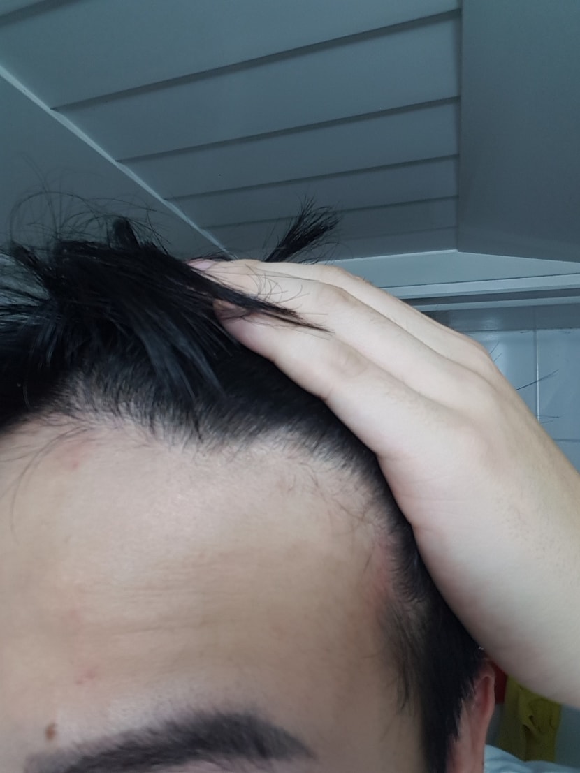 이마라인왼쪽