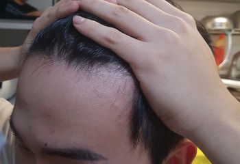 이마라인왼쪽