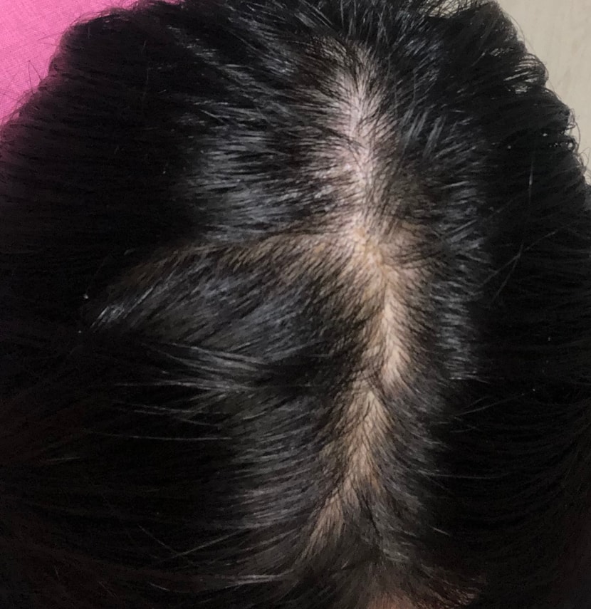 마이녹실 바르기전