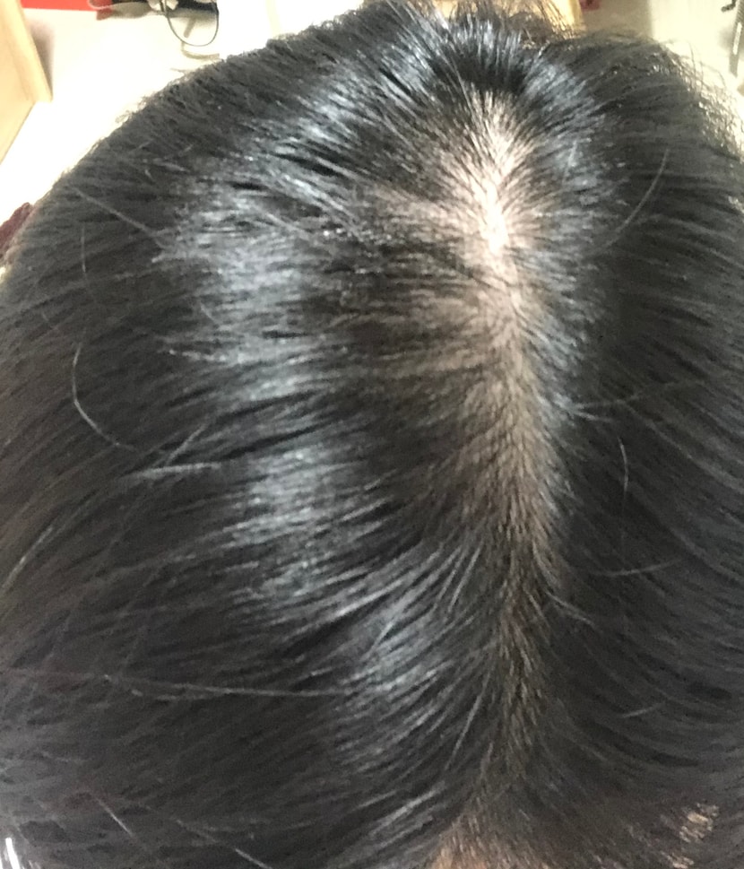 마이녹실 두달후