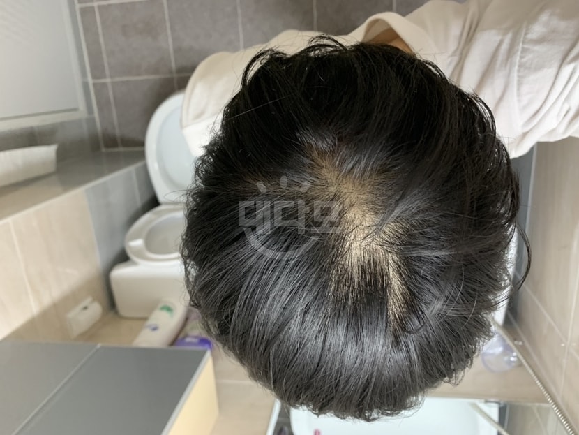 이건 심각성 깨닫고 복용하기 시작했을때