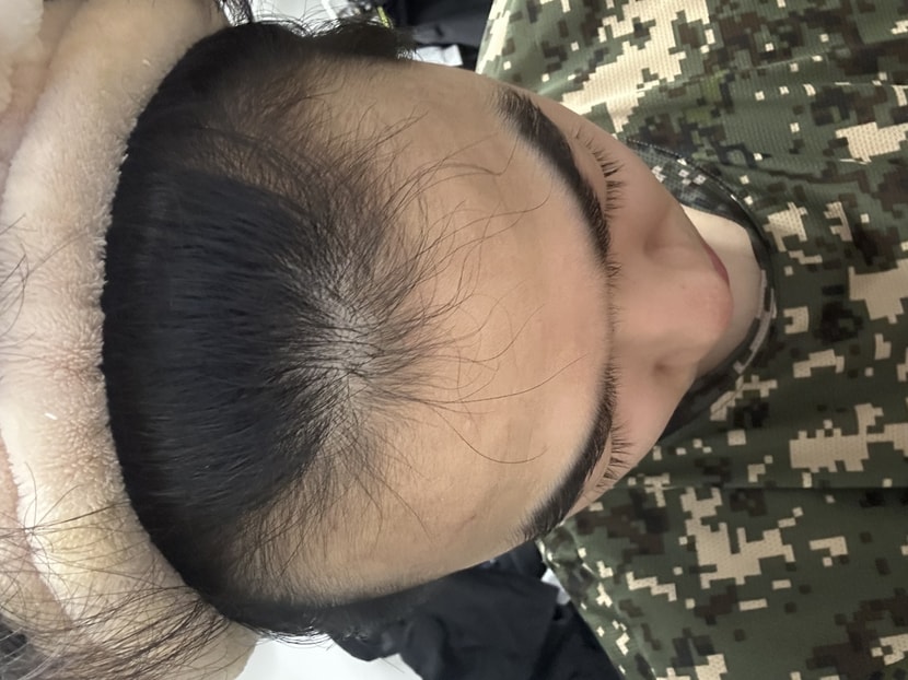 머리 m자 사진 ㅠㅠㅠ