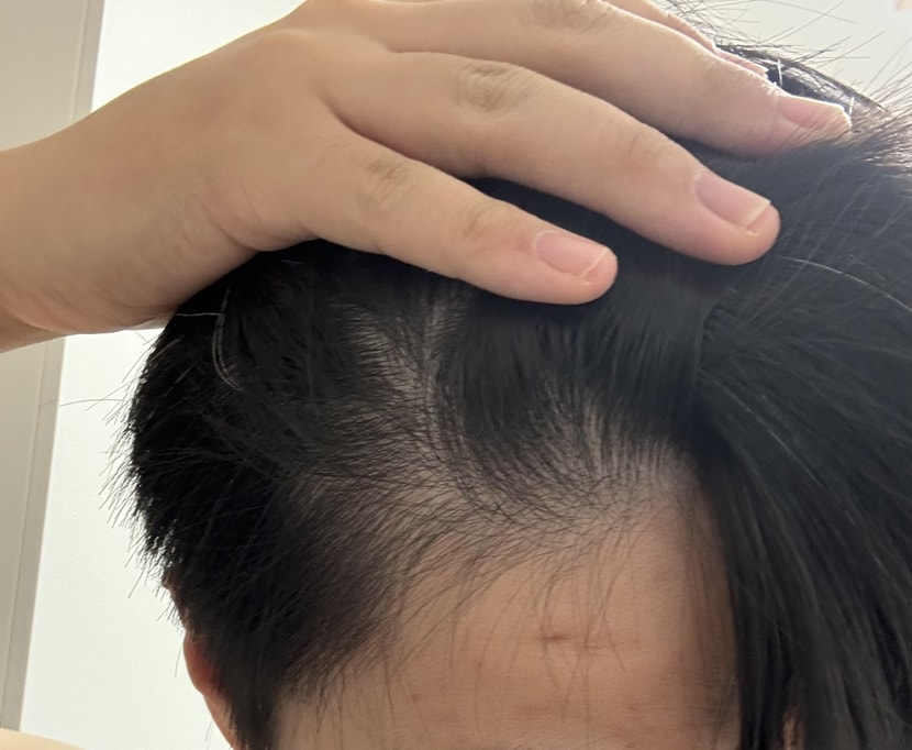 오른쪽 이마 사진