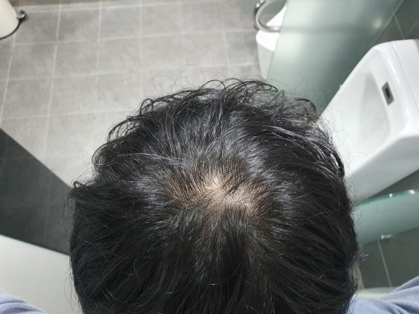 약먹은지 1년4개월정도됨