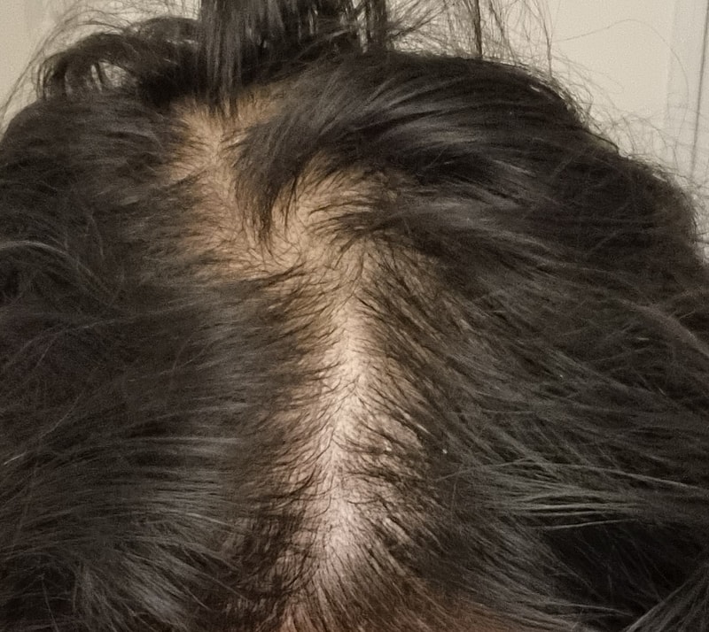 はぁ…学生の時から薄毛でした