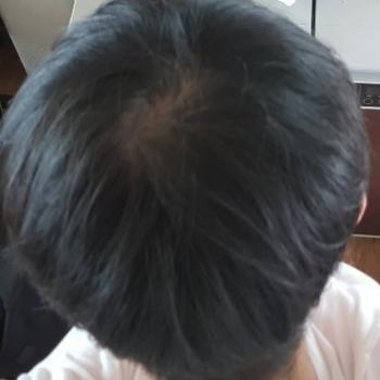 1년동안 잠4시간 자고 식습관 불균형으로 정수리 털림 2018