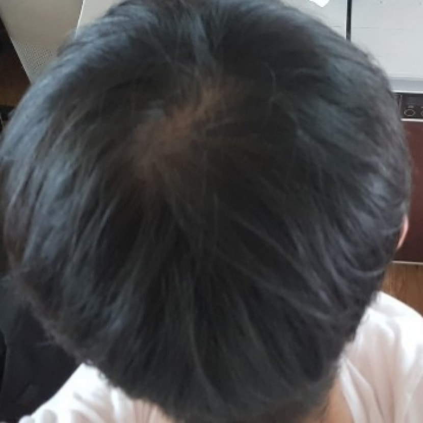 1년동안 잠4시간 자고 식습관 불균형으로 정수리 털림 2018