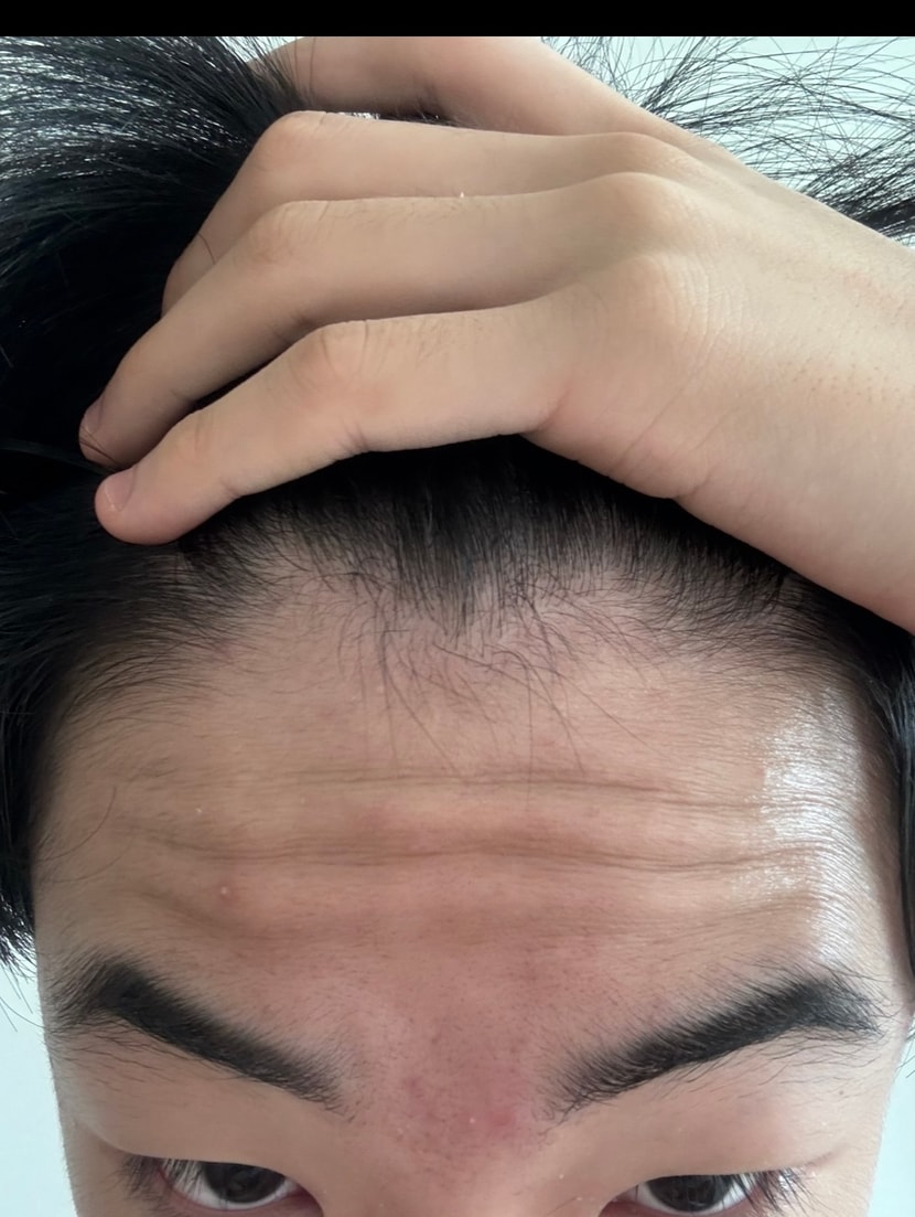 예전 앞머리 두피