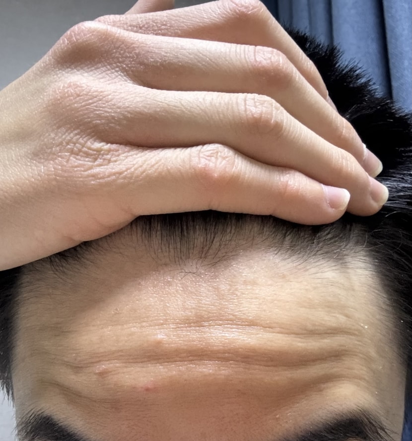 현재 앞머리 두피