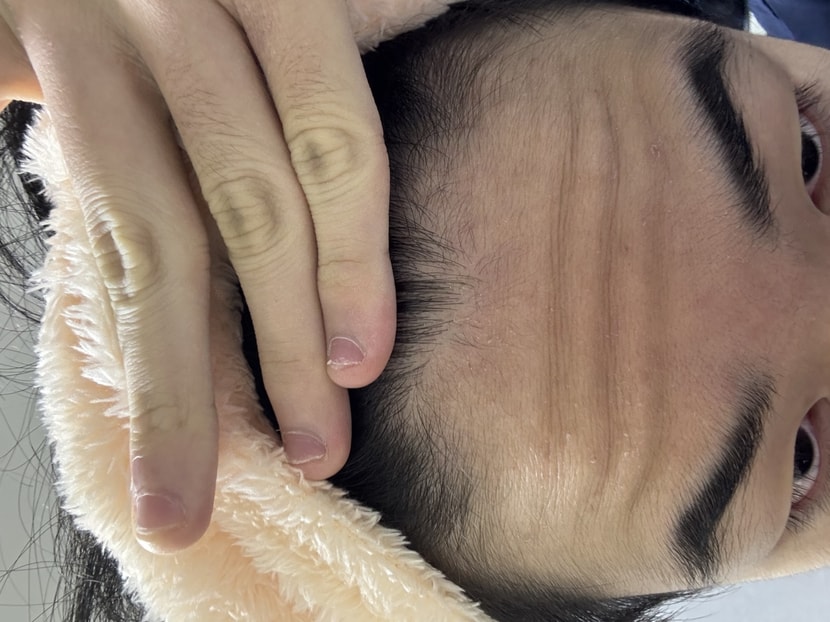 현재 앞머리 두피