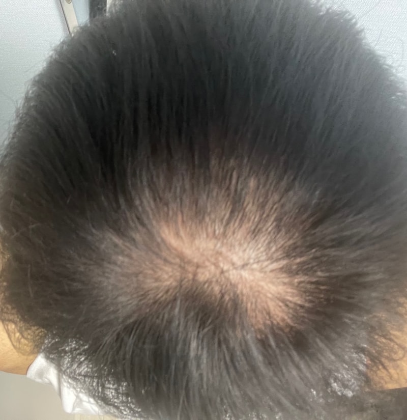 25살 탈모 죽고싶음