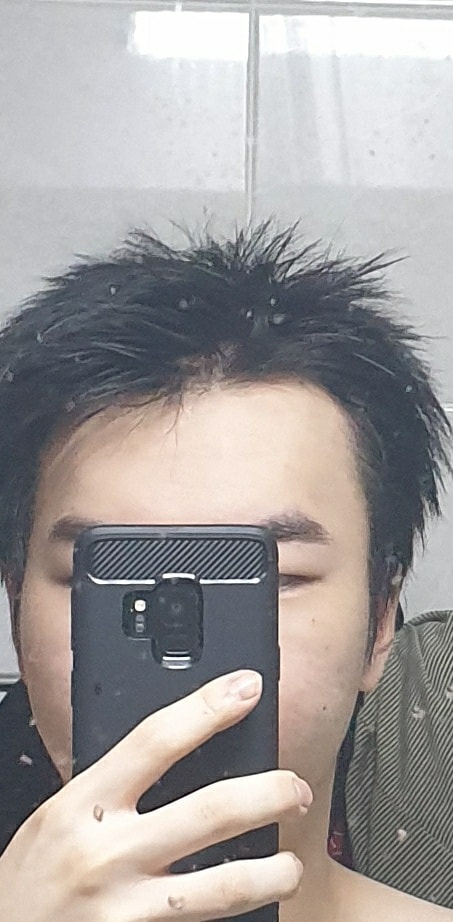 20년 5월입니다. 이때즈음부터 피나계열을 종로보람의원에서 받았습니다.