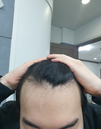 21년 4월입니다. 지속적으로 빠지는 게 보여서 종로보람의원 재방문해서 찍은 사진입니다.