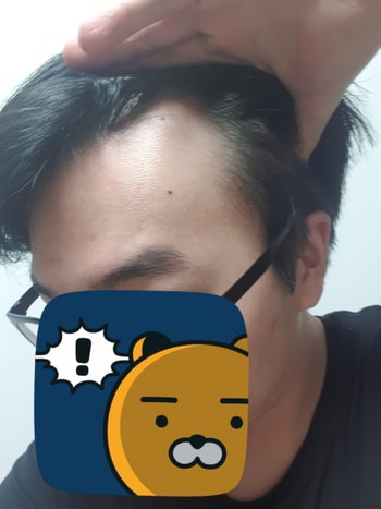 22년 1월 현재입니다. 오른쪽 M자 때문에 앞머리를 내리질 못합니다. 8대2가르마조차 모량이 적어 어렵습니다. 