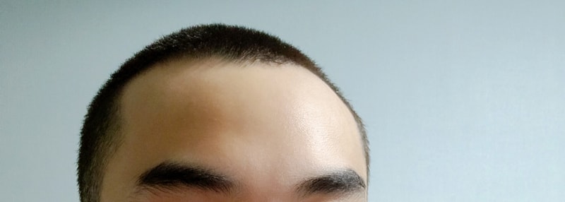 M字严重到什么程度呢?