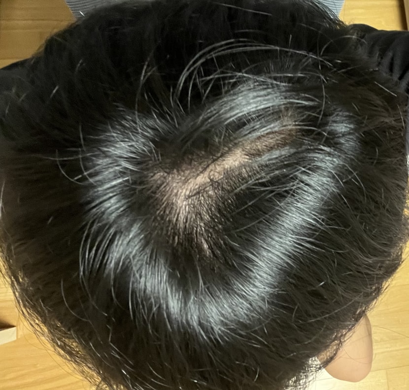 정수리 탈모 맞나요??