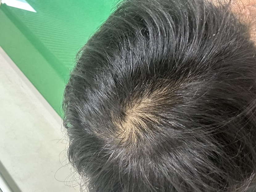 탈모인지 궁금합니더....