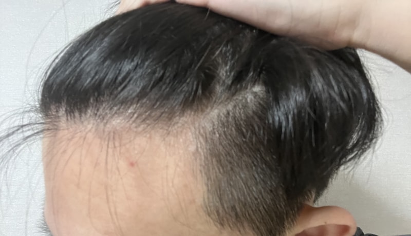 感觉是20岁脱发吧？