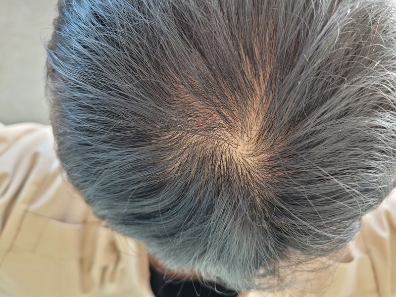 프로페시아 복용 시작합니다....