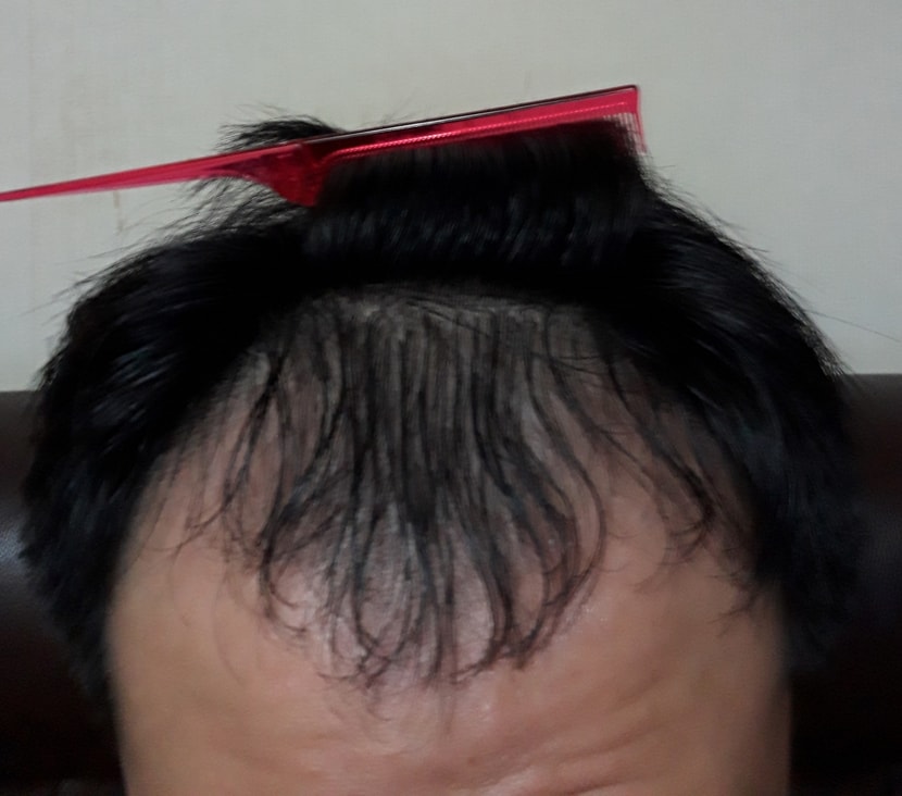 미녹시딜을 바르고 나서 찍은 사진.