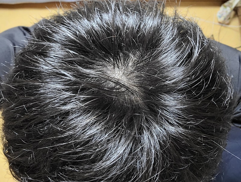 21歳薄毛の初期診断を受ける