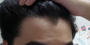 오른쪽 왼쪽이 더 숫이 적음