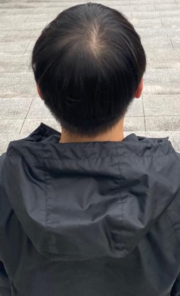 22세 남성 탈모인가요 이거? 원래 가늘고 얇았는데 유독 힘 없고 가는 것 같은 요즘