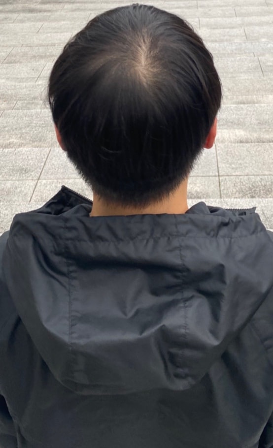 22세 남성 탈모인가요 이거? 원래 가늘고 얇았는데 유독 힘 없고 가는 것 같은 요즘