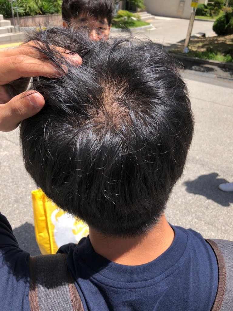 이게 작년여름에 친구가찍은거고 이때부터약먹기시작