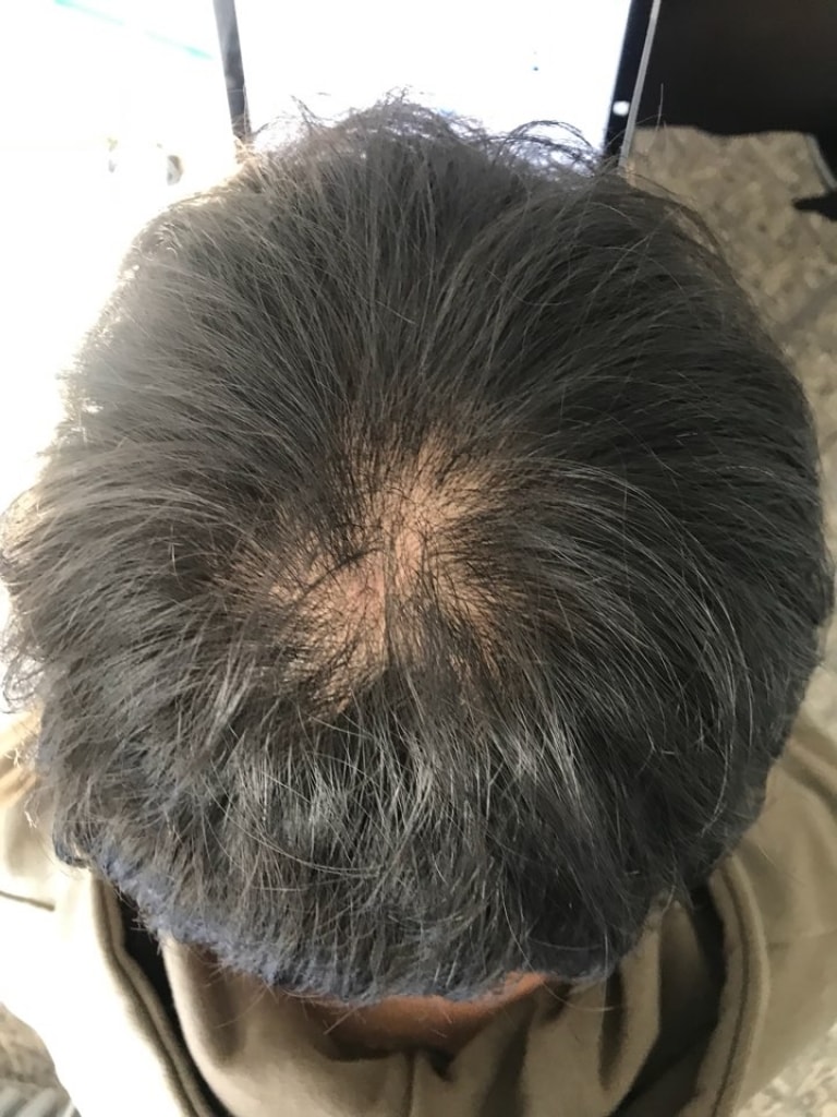 이건 바로피나 먹고 한 3달? 가을쯤