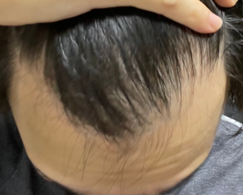 22歳の遺伝子薄毛