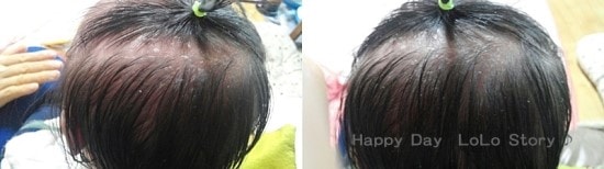 아기각질상태