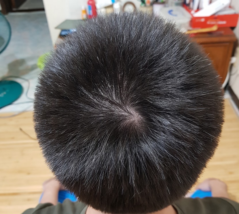 정수리2